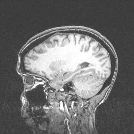 A sagittal MRI scan showing a side view of the human brain and skull