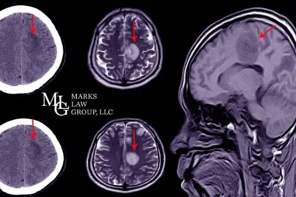 CT and MRI brain scans with red arrows marking an injury