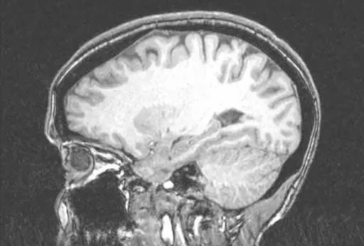 Side-view MRI scan of a human head showing the brain