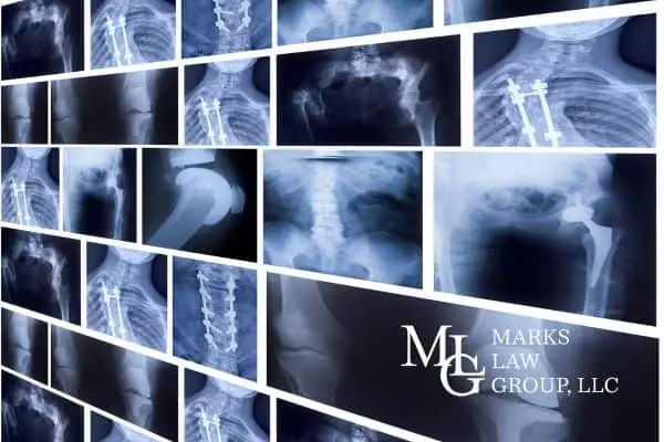 A wall of backlit spine, hip and shoulder X-rays, several showing surgical screws